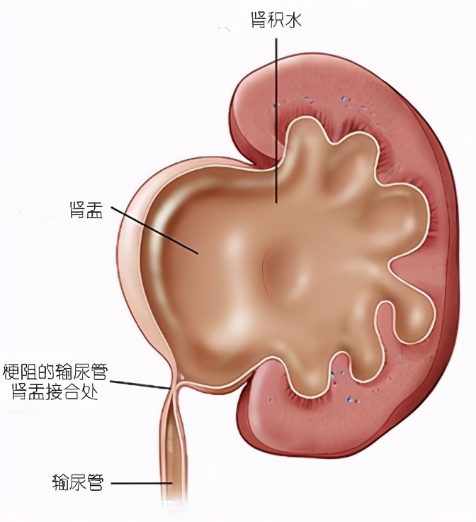 腎積水會導致腎皮質萎縮,繼而影響腎功能