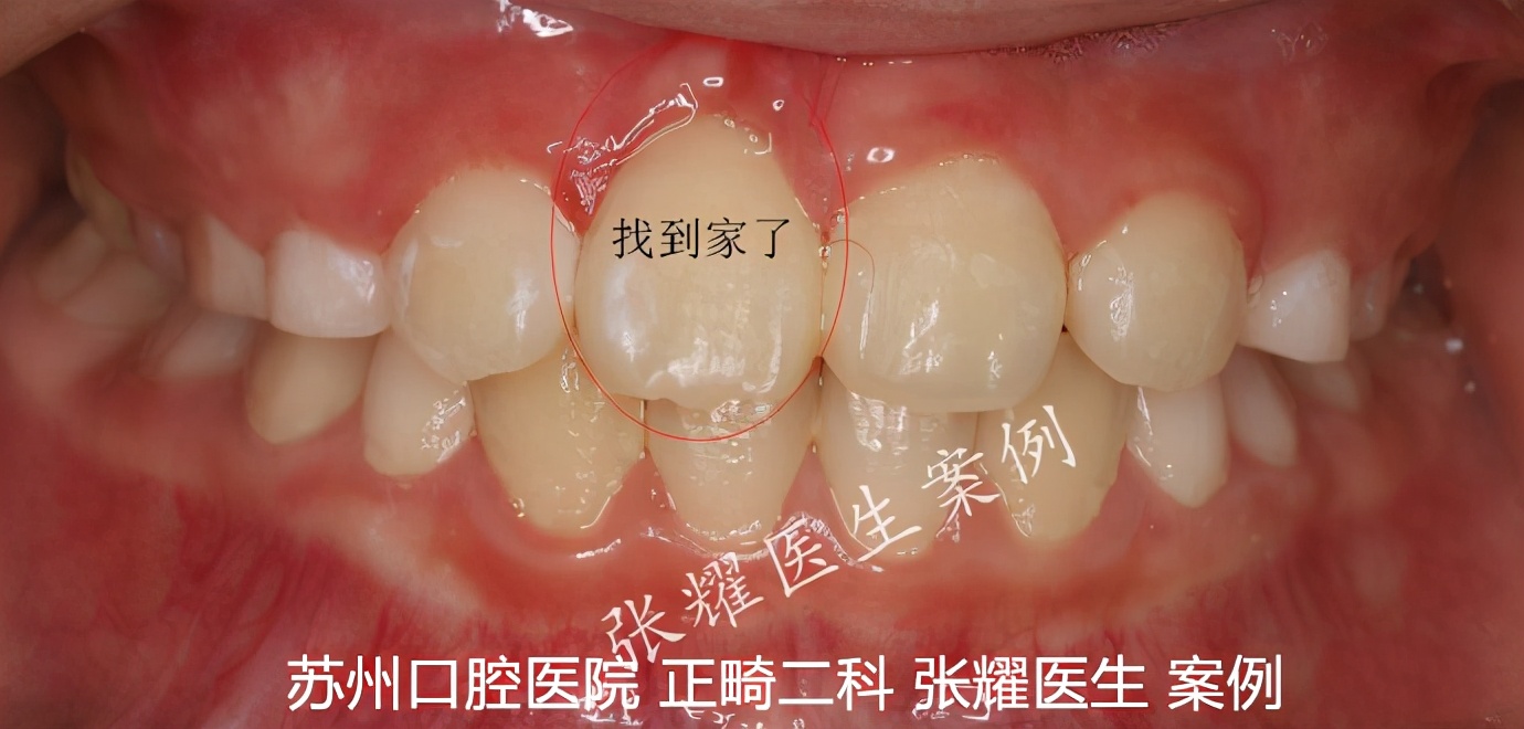 为什么90%的儿童口腔问题，源于啃手指、吐舌头、嘴呼吸等习惯？