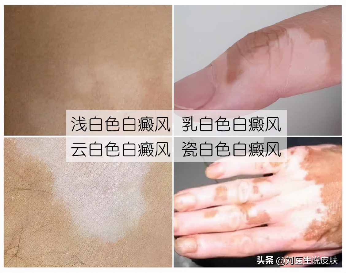 治疗白癜风不用愁！收好这份<就诊指南>，安全有效，祛白不走弯路