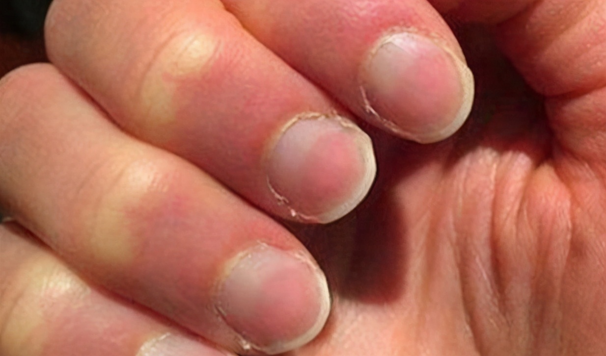 肾衰竭"刚萌芽"时,身体隐约有4个反常,别硬撑到"尿毒症"