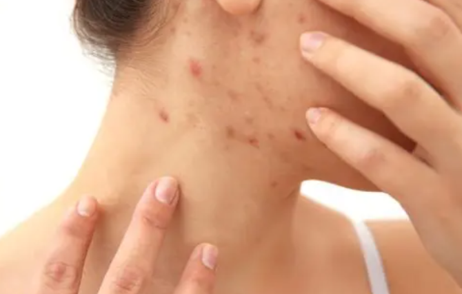 脖子和腋下的“小肉粒”是什么？可以用手直接扣掉吗？要引起重视