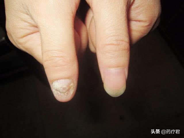 什么是灰指甲图片(灰指甲，易传染还难治，正规医院治不了？医生：这太小儿科了)