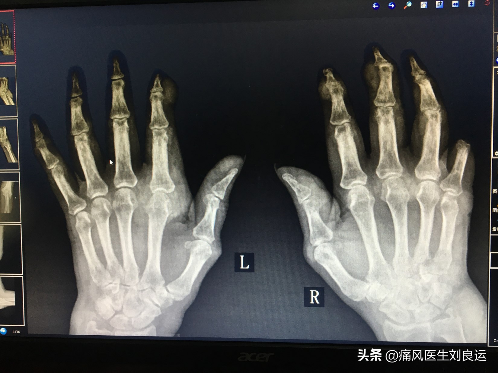 痛风石可以做手术取石吗？如何清除关节处尿酸盐结晶和积液？