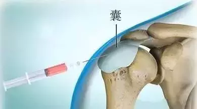 科普:封闭针,究竟是“毒”还是“药”?