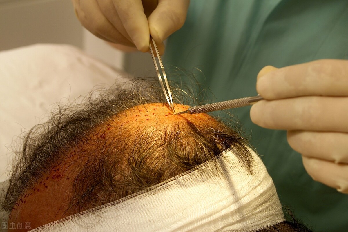 头发种植多少钱可以做收费标准及价格详解