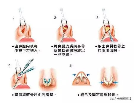 鼻翼缩小有什么神力，小樱花、金南珠等一众明星都在做？