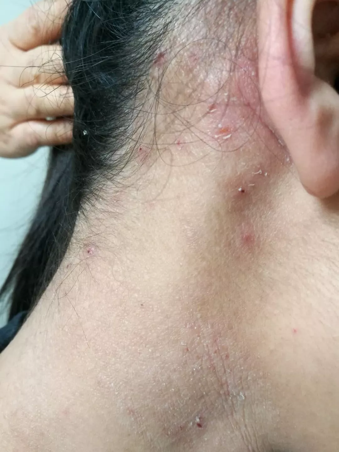 过敏体质除了治疗,还有这些关键点