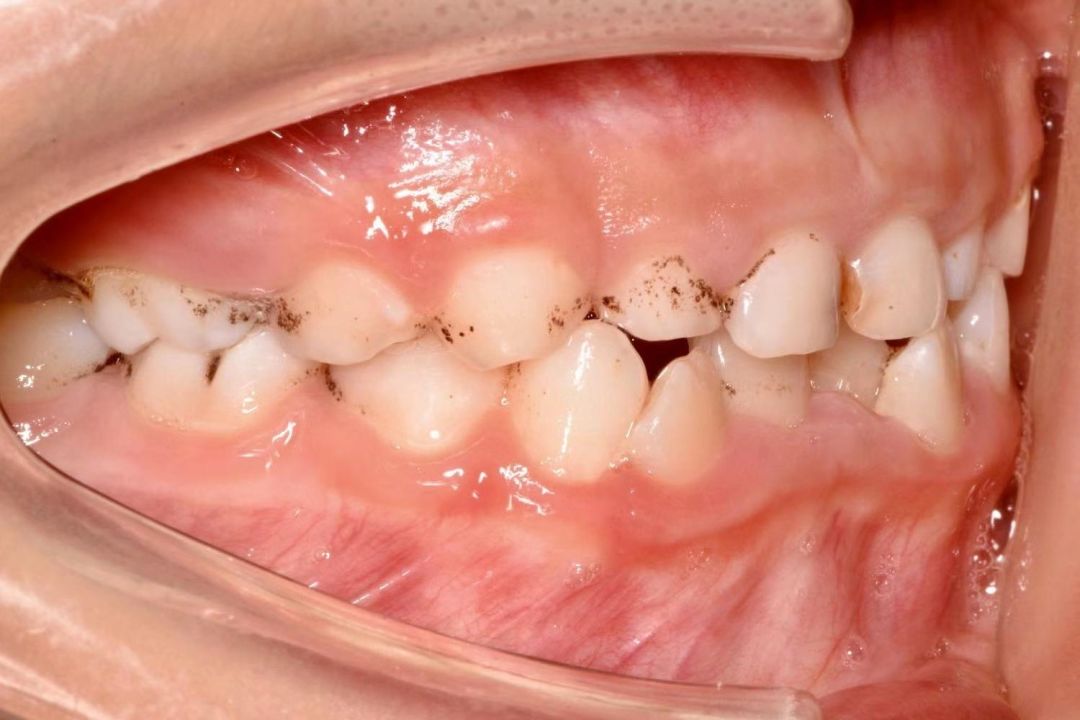 宝宝牙齿上的"黑点点"真碍眼,能去掉吗?