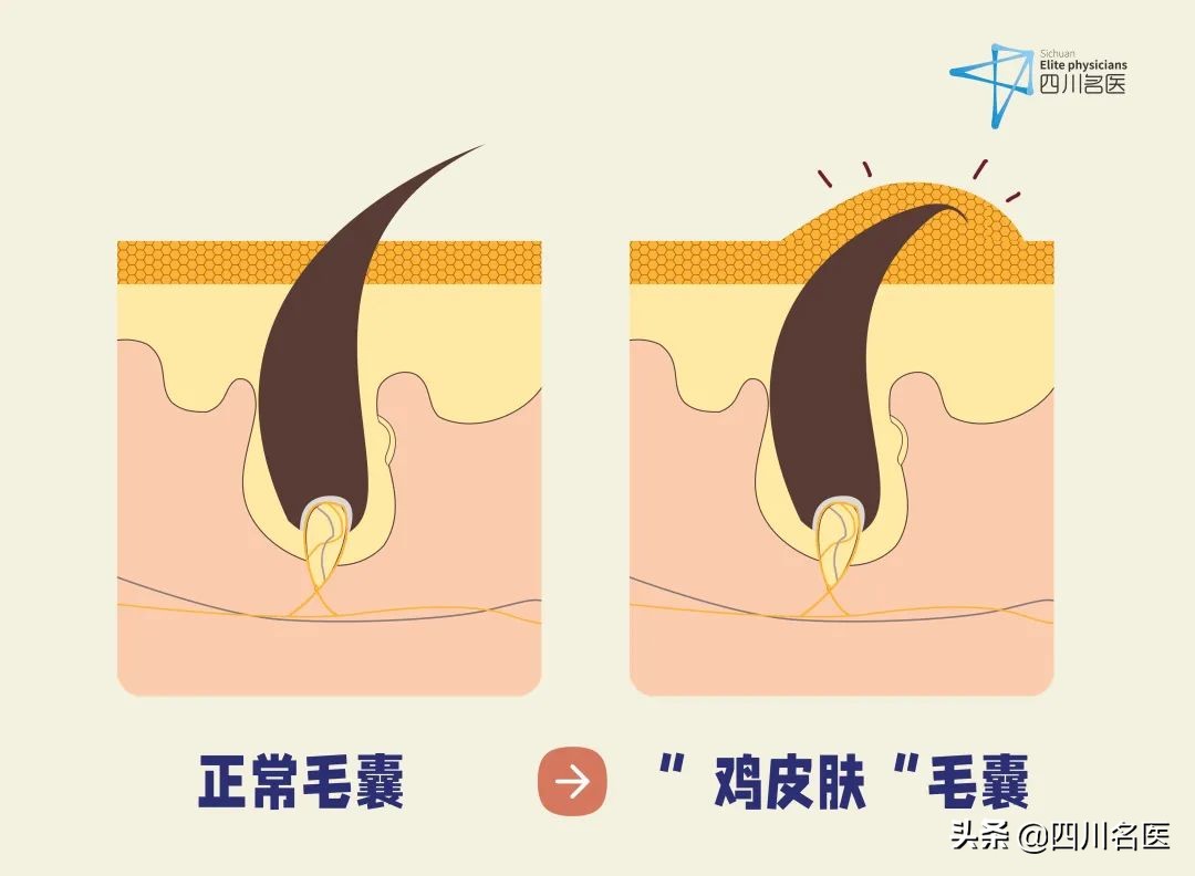 难看的“鸡皮肤”，到底还有没有救？华西皮肤科医生来支招