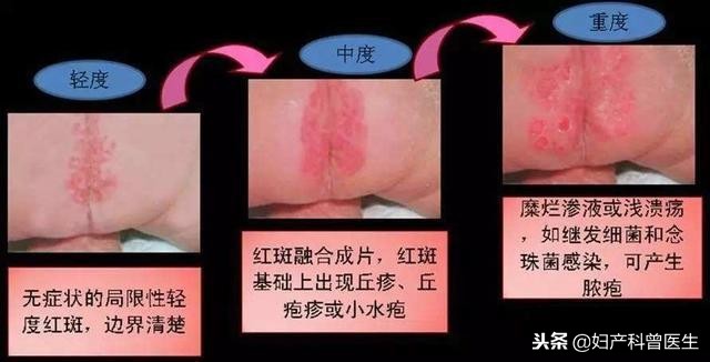 让宝宝难受哭闹的“红屁股”，传授5招，从此妈妈不再为此头疼