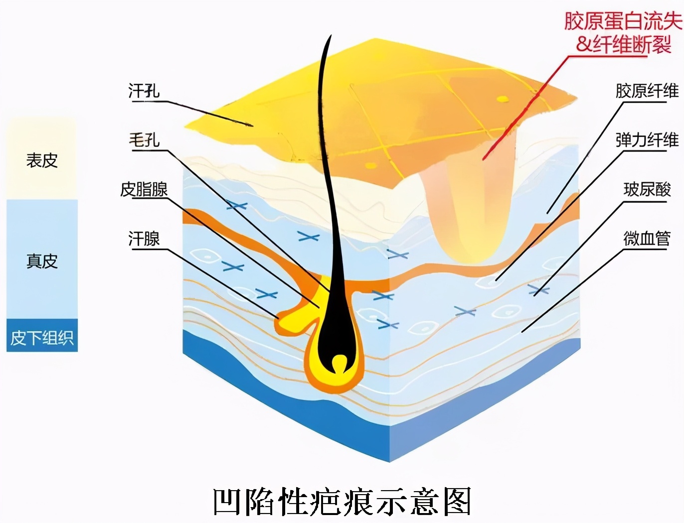 凹陷和凸起，疤痕为什么会产生不同？