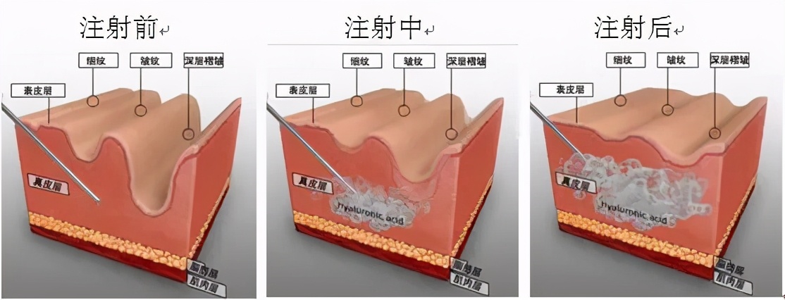 感觉玻尿酸吸收快，都与哪些因素有关？