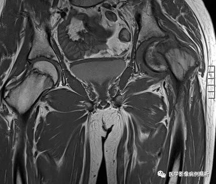 垂体柄阻断综合征并股骨头骨骺滑脱MR典型影像表现及分析思路