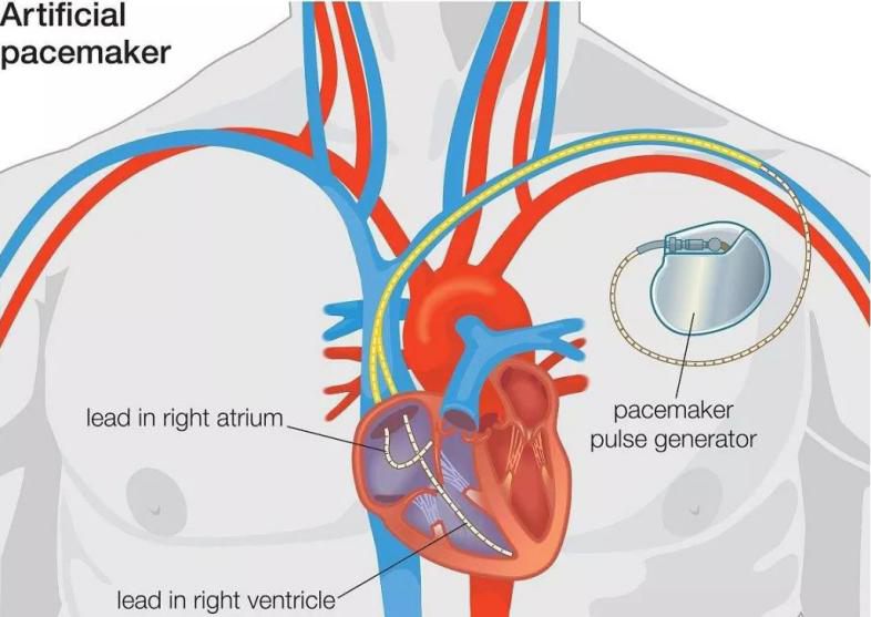 它是一种帮助维持心脏搏动的小型植入设备,主要包括脉冲发生器和电极