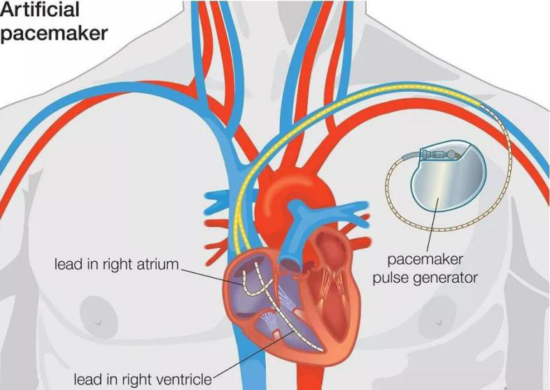 最低三万，最高十几万，装个心脏起搏器，为什么这么贵？