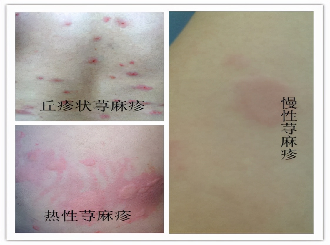 荨麻疹瘙痒难耐、夜不能寐？教你4个方法快速止痒
