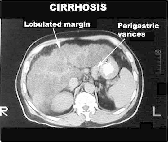 肝弹准确吗？肝病专家详解B超、CT、磁共振等肝硬化的无创检查！