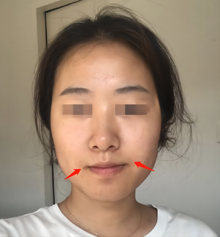 面部不对称的脸应该如何改善?