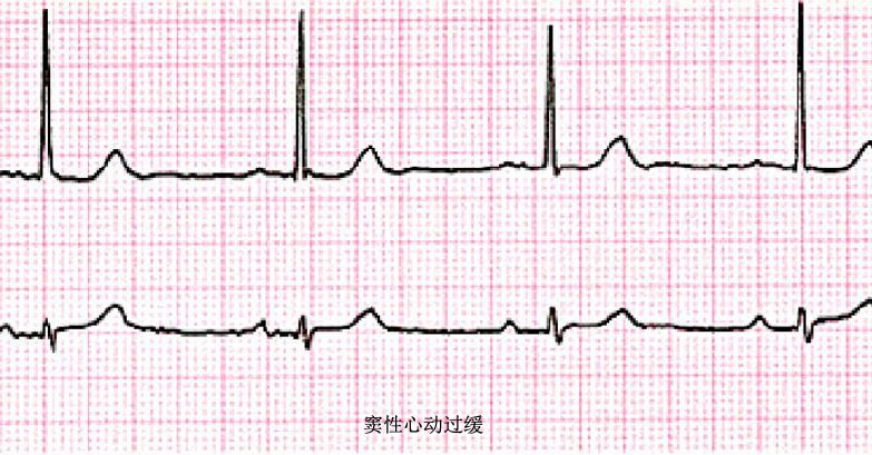 窦性心律到底是怎么回事-窦性心律是什么意思 - 114知识网