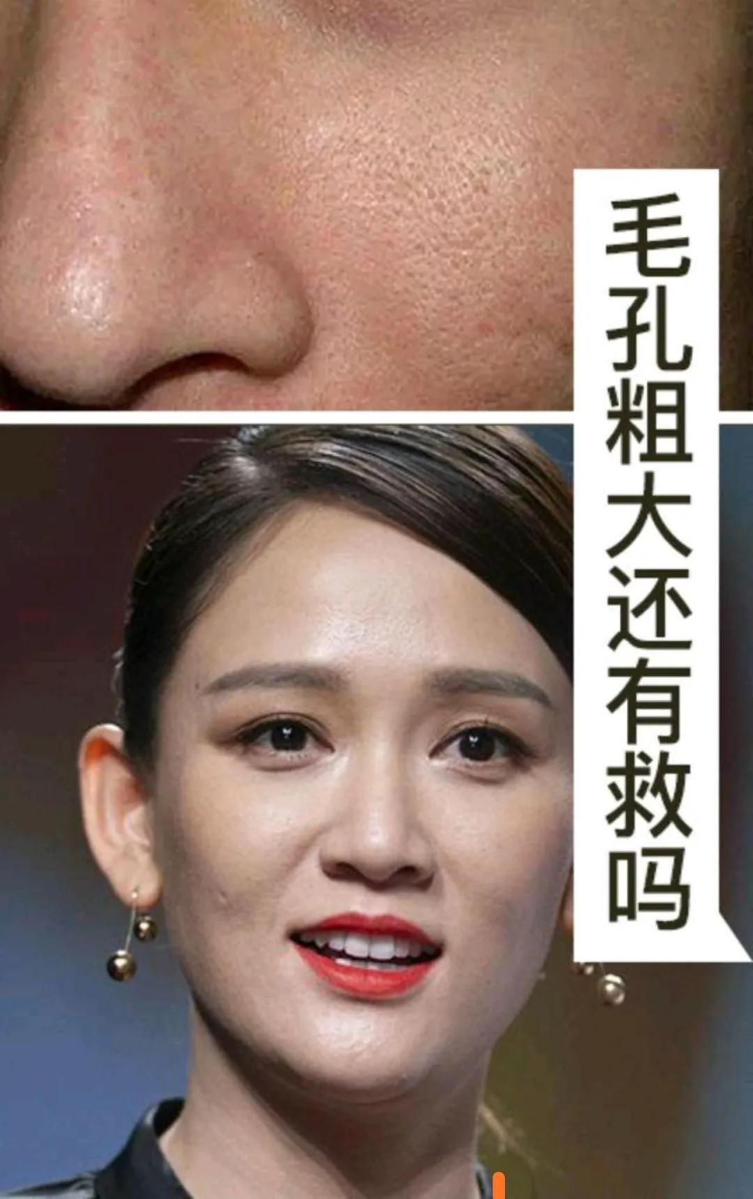 毛孔粗大还有救吗？你知的缩毛孔方法都没用
