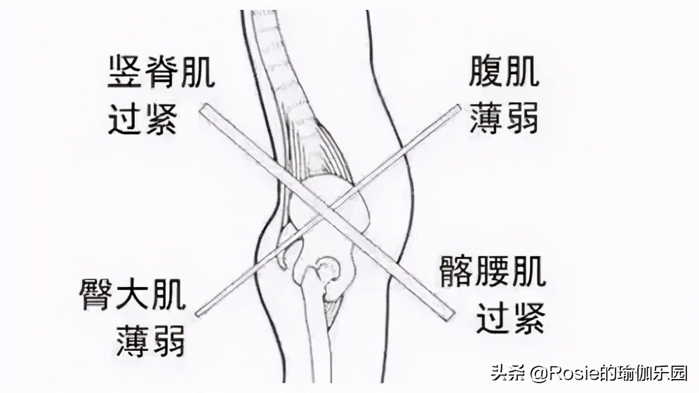 秦海璐小腹凸出怀二胎？原来是骨盆前倾惹的祸，这样5步回正骨盆