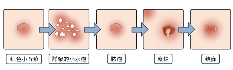 为什么有的男人会选择嫖娼？一次嫖娼会带来多少性病？长点记性吧