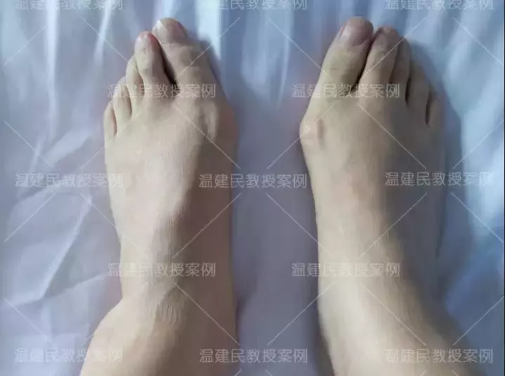 案例:轻度拇外翻不治疗,拖延20年成重度,疼痛难忍才来手术