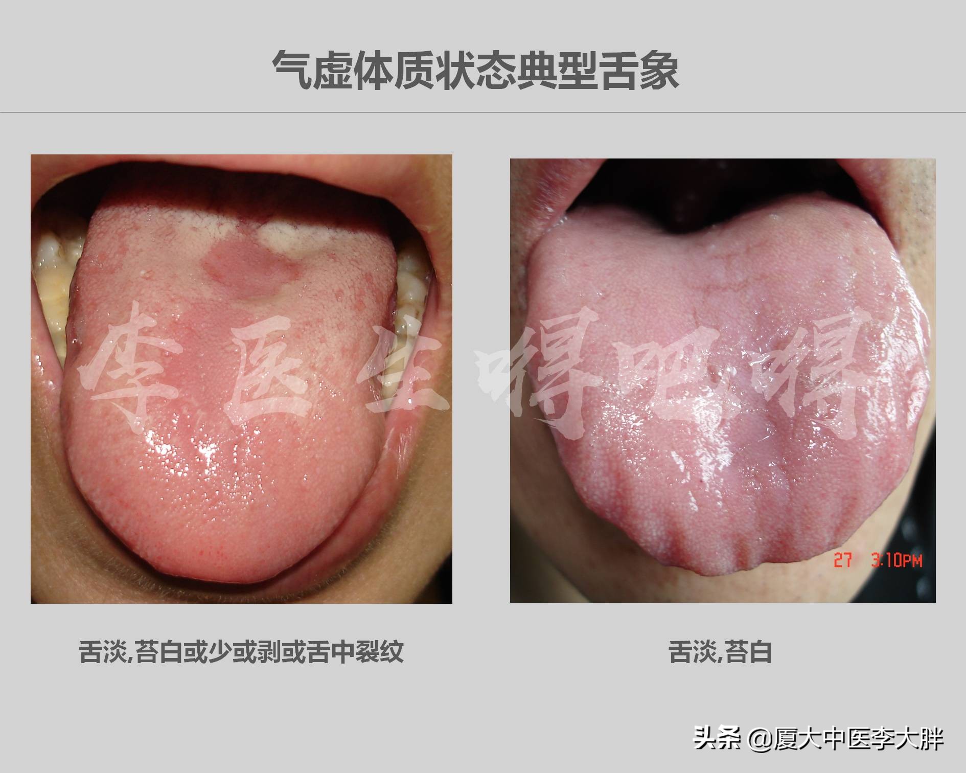 气虚如何调养？
