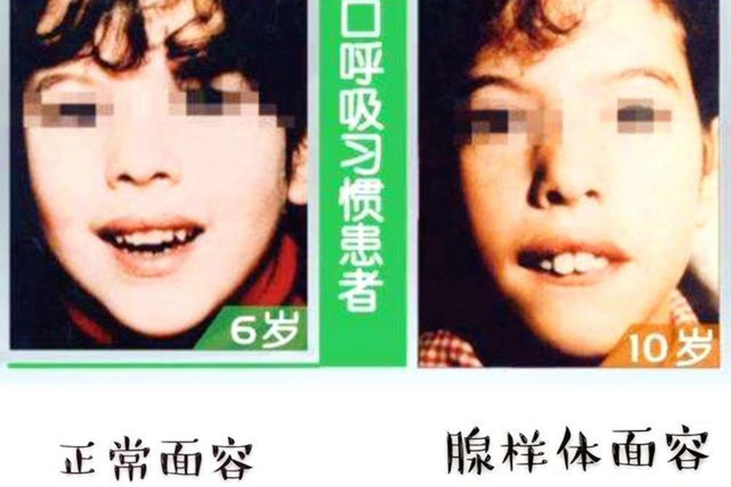 孩子“嘴部”越长越难看，不是环境影响颜值，可能是睡觉的坏习惯