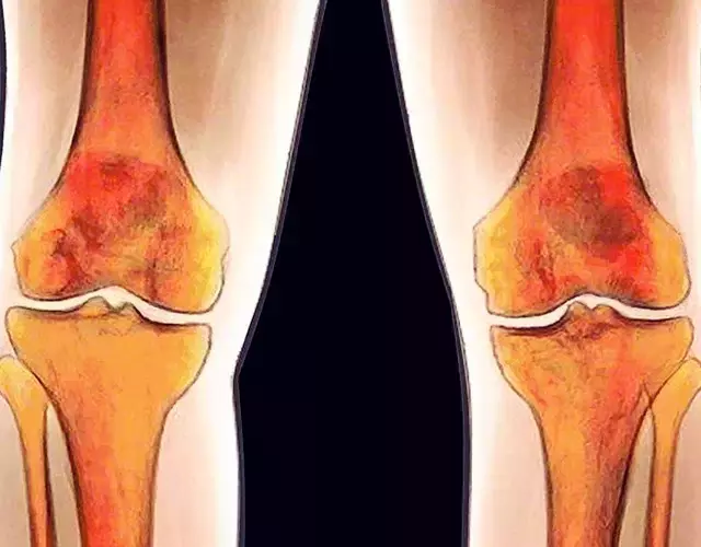 膝关节结构图,膝关节结构图高清