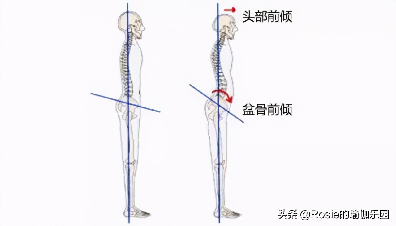 秦海璐小腹凸出怀二胎？原来是骨盆前倾惹的祸，这样5步回正骨盆