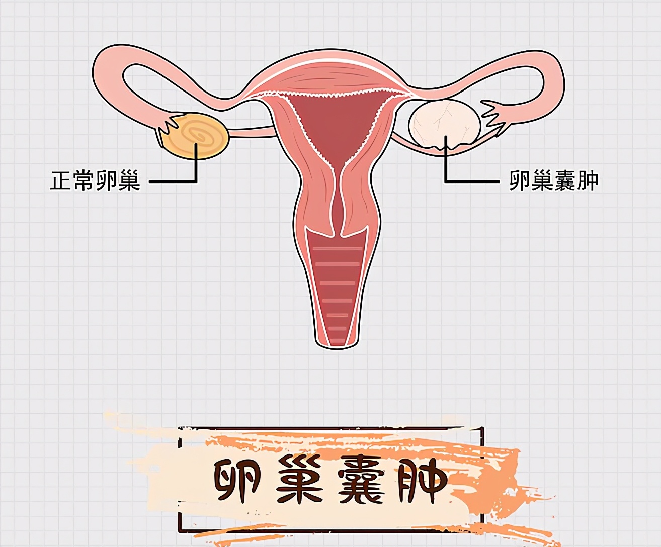 卵巢囊肿的四大常见诱因解析