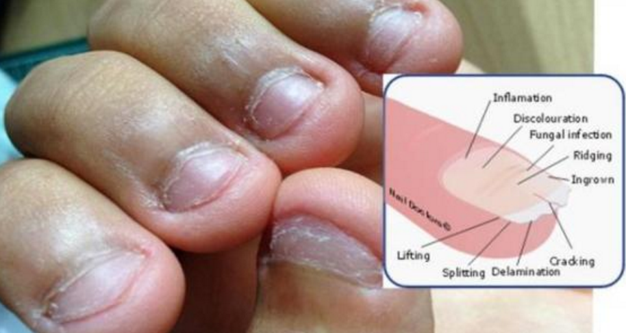 但如果孩子咬指甲没有纠正的话,甲床经常受外伤,可能时不时就会出现白