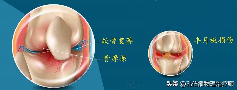 膝关节在下蹲、上下楼梯疼，还会响，为何？盘点6个原因，请收藏