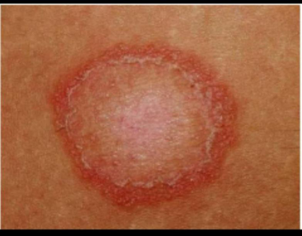 上覆糠秕样鳞屑的玫瑰色的斑丘疹,先有母斑,可能是玫瑰糠疹