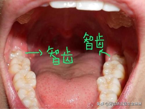 长智齒导致牙龈腫痛怎么办？淄博拔智齒推荐医院