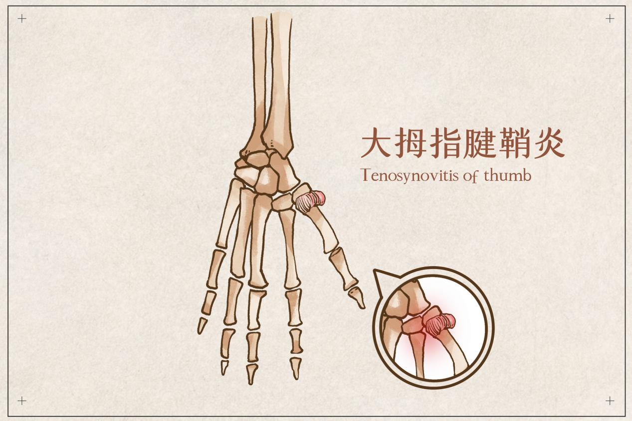 手指腱鞘炎最佳治疗方法