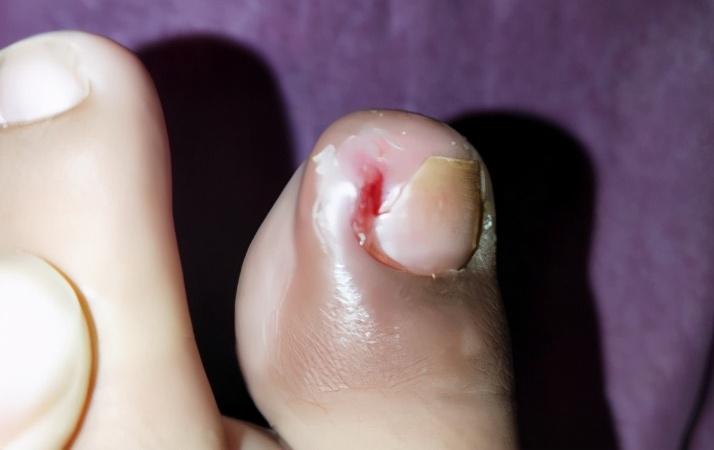 脚趾甲老往肉里长,得了「嵌甲」怎么办?医生:你需要了解这3点