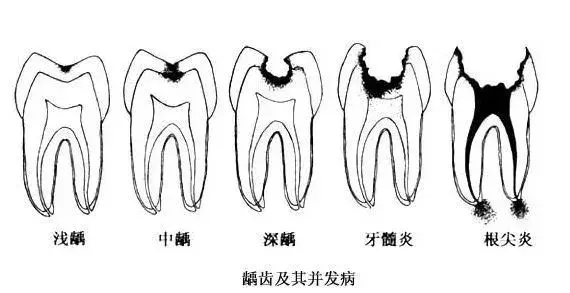 补牙要趁早!小龋坏久拖不治,最后花费上万,冤不冤?