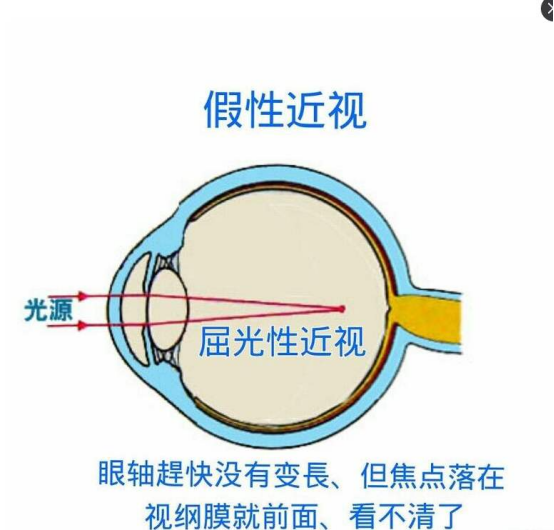 什么是儿童假性近视 如何区别假性近视、真近视？