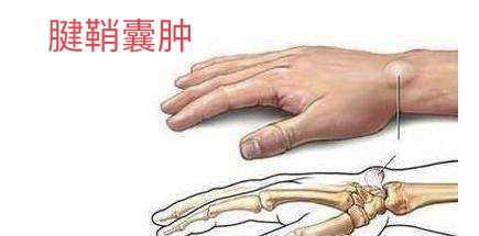 腱鞘囊肿的治疗方法与处理建议