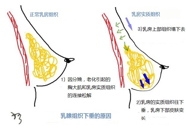 杨幂的胸为什么变这么大了