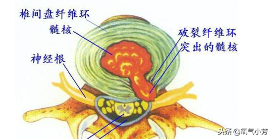 腰突症，不要再花冤枉钱了，你的自愈力与自律程度，才是恢复根本