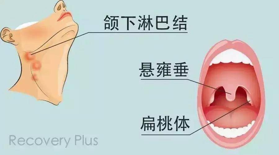 扁桃体发炎最快治疗方法 扁桃体在什么位置