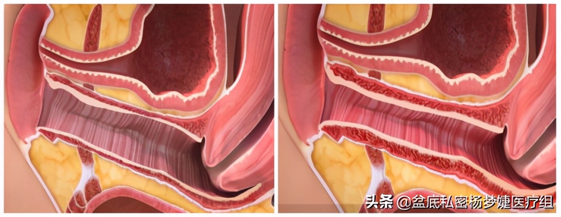 「女性之声」“紧”上添花，摆脱无性婚姻