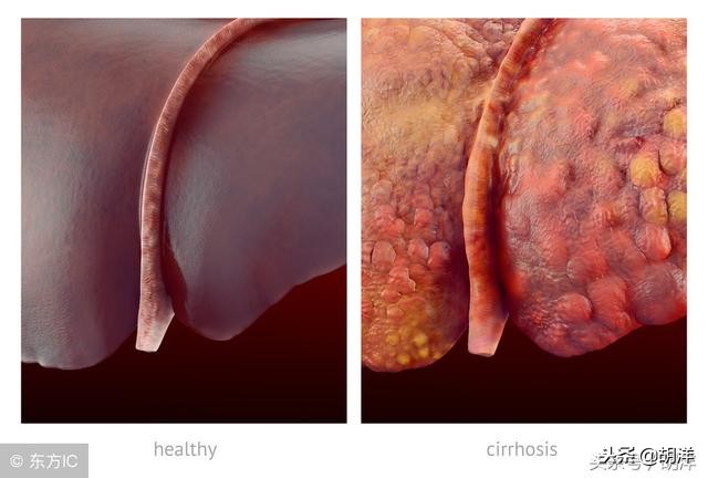 右肝钙化灶是什么意思图片