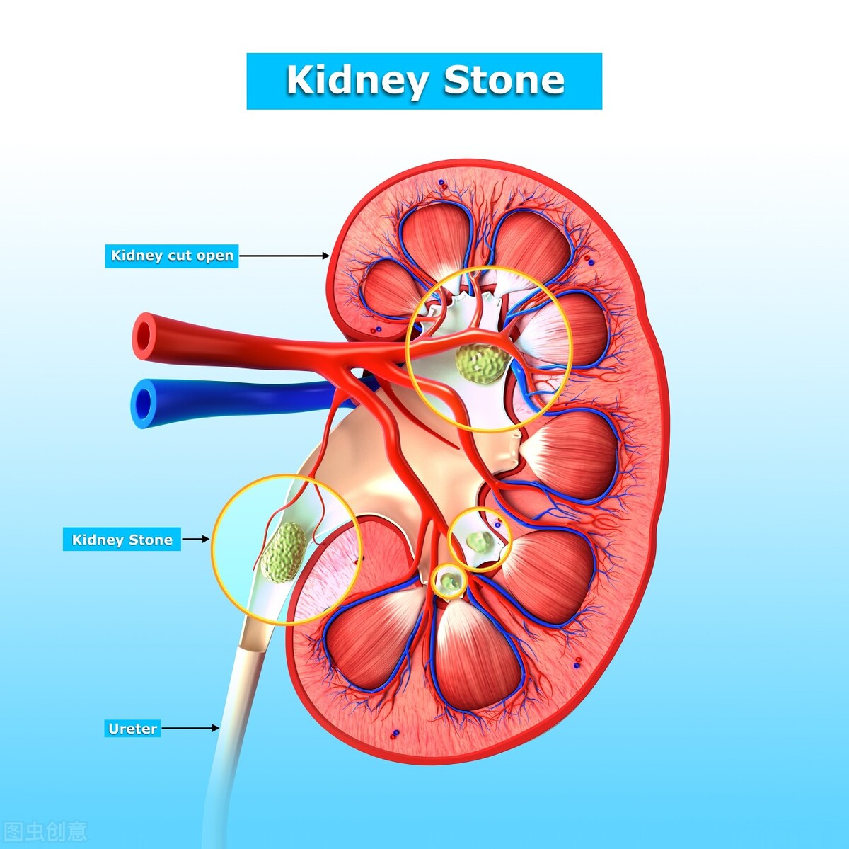 肾结石的疼痛要如何缓解？这6种方法更有效！值得一看
