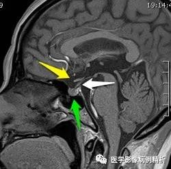 垂体柄阻断综合征并股骨头骨骺滑脱MR典型影像表现及分析思路