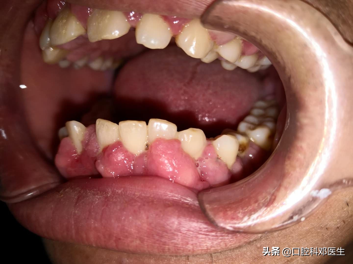 牙龈颗粒状增生图片