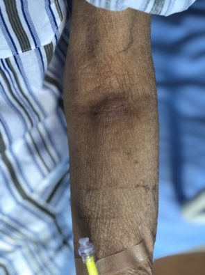 静脉输血后四级静脉炎，氧疗+水胶体贴敷轻松搞定